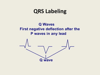 QRS Labeling
Q Waves
First negative deflection after the
P waves in any lead
Q wave
 