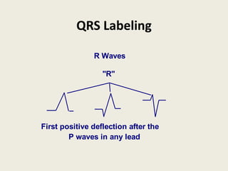 QRS Labeling
R Waves
First positive deflection after the
P waves in any lead
"R"
 