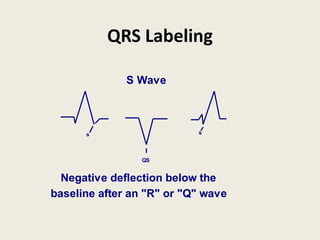 QRS Labeling
S Wave
Negative deflection below the
baseline after an "R" or "Q" wave
s
QS
s
 