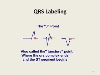 QRS Labeling
The "J" Point
Also called the" juncture" point.
Where the qrs complex ends
and the ST segment begins
32
 