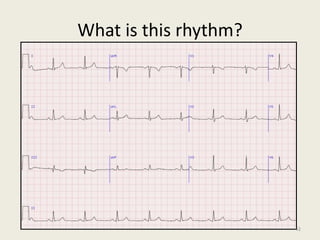 What is this rhythm?
42
 