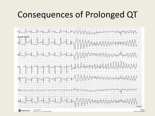 Consequences of Prolonged QT
45
 