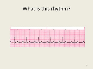 What is this rhythm?
47
 