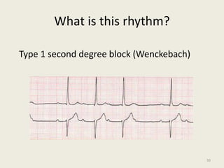What is this rhythm?
Type 1 second degree block (Wenckebach)
50
 