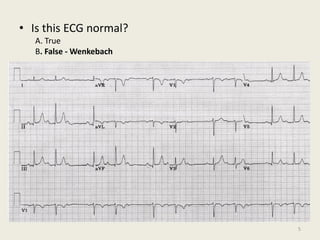 • Is this ECG normal?
A. True
B. False - Wenkebach
5
 