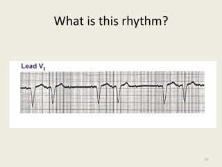 What is this rhythm?
51
 