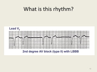 What is this rhythm?
52
 