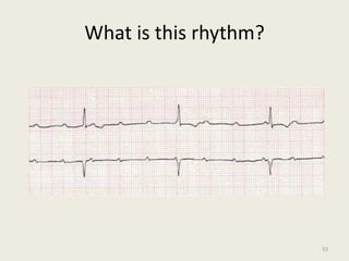 What is this rhythm?
53
 