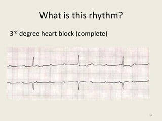 What is this rhythm?
3rd degree heart block (complete)
54
 