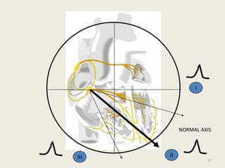 III II
I
NORMAL AXIS
57
 