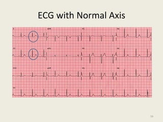 ECG with Normal Axis
59
 
