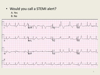 • Would you call a STEMI alert?
A. Yes
B. No
6
 