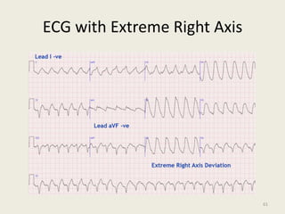 ECG with Extreme Right Axis
61
 