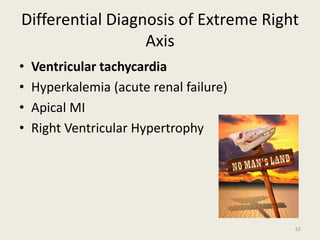 Differential Diagnosis of Extreme Right
Axis
• Ventricular tachycardia
• Hyperkalemia (acute renal failure)
• Apical MI
• Right Ventricular Hypertrophy
62
 