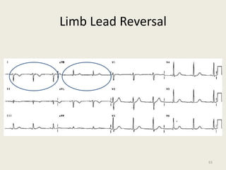 Limb Lead Reversal
63
 