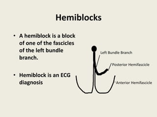 Hemiblocks
• A hemiblock is a block
of one of the fascicles
of the left bundle
branch.
• Hemiblock is an ECG
diagnosis
Left Bundle Branch
Posterior Hemifascicle
Anterior Hemifascicle
 