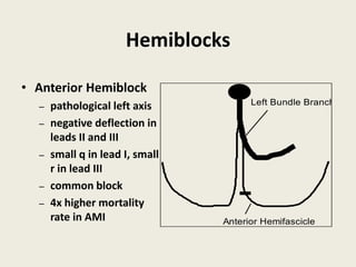 Hemiblocks
• Anterior Hemiblock
– pathological left axis
– negative deflection in
leads II and III
– small q in lead I, small
r in lead III
– common block
– 4x higher mortality
rate in AMI
Left Bundle Branch
Anterior Hemifascicle
 