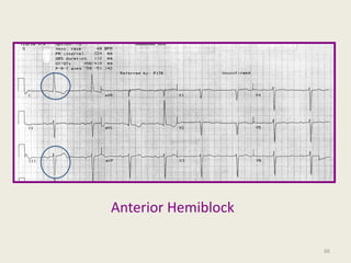 Anterior Hemiblock
66
 