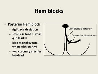 Hemiblocks
• Posterior Hemiblock
– right axis deviation
– small r in lead I, small
q in lead III
– high mortality rate
when with an AMI
– two coronary arteries
involved
Left Bundle Branch
Posterior Hemifascicl
 