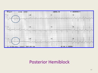 Posterior Hemiblock
69
 