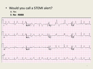 • Would you call a STEMI alert?
A. Yes
B. No - RBBB
7
 