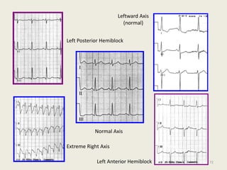 Normal Axis
Leftward Axis
(normal)
Left Anterior Hemiblock
Left Posterior Hemiblock
Extreme Right Axis
72
 