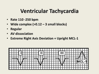 Ventricular Tachycardia
• Rate 110 -250 bpm
• Wide complex (>0.12 – 3 small blocks)
• Regular
• AV dissociation
• Extreme Right Axis Deviation + Upright MCL-1
I II
I II III
MCL-1
 