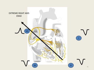I
II
III
EXTREME RIGHT AXIS
ERAD
V1
75
 