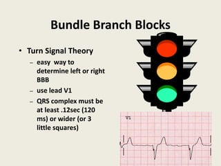 Bundle Branch Blocks
• Turn Signal Theory
– easy way to
determine left or right
BBB
– use lead V1
– QRS complex must be
at least .12sec (120
ms) or wider (or 3
little squares)
 