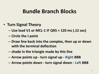 Bundle Branch Blocks
• Turn Signal Theory
– Use lead V1 or MCL-1 IF QRS > 120 ms (.12 sec)
– Circle the J point
– Draw line back into the complex, then up or down
with the terminal deflection
– shade in the triangle made by this line
– Arrow points up - turn signal up - Right BBB
– Arrow points down - turn signal down - Left BBB
79
 