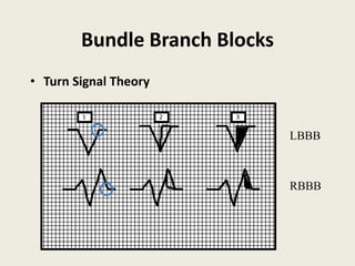 Bundle Branch Blocks
• Turn Signal Theory
1 2 3
LBBB
RBBB
 