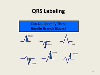 QRS Labeling
QRS Morphologies
Can you label these complexes?
RBBB
LBBB LBBB
LBBB
RBBB RBBB
Can You Identify These
Bundle Branch Blocks?
81
 