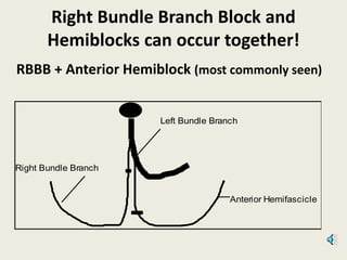 Right Bundle Branch Block and
Hemiblocks can occur together!
RBBB + Anterior Hemiblock (most commonly seen)
Left Bundle Branch
Anterior Hemifascicle
Right Bundle Branch
 