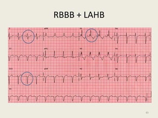 RBBB + LAHB
83
 