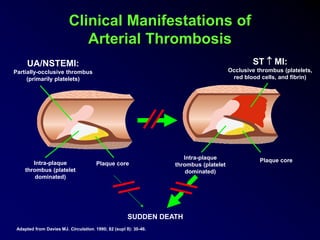 Clinical Manifestations of
Arterial Thrombosis
UA/NSTEMI:
Partially-occlusive thrombus
(primarily platelets)
Intra-plaque
thrombus (platelet
dominated)
Plaque core
ST  MI:
Occlusive thrombus (platelets,
red blood cells, and fibrin)
Intra-plaque
thrombus (platelet
dominated)
Plaque core
SUDDEN DEATH
Adapted from Davies MJ. Circulation. 1990; 82 (supl II): 30-46.
 