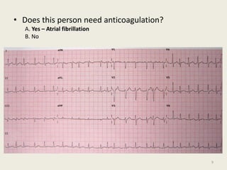 • Does this person need anticoagulation?
A. Yes – Atrial fibrillation
B. No
9
 