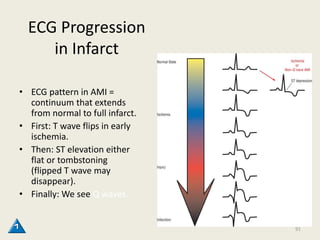 ECG Progression
in Infarct
• ECG pattern in AMI =
continuum that extends
from normal to full infarct.
• First: T wave flips in early
ischemia.
• Then: ST elevation either
flat or tombstoning
(flipped T wave may
disappear).
• Finally: We see Q waves.
91
 