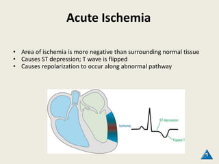 Acute Ischemia
• Area of ischemia is more negative than surrounding normal tissue
• Causes ST depression; T wave is flipped
• Causes repolarization to occur along abnormal pathway
95
 