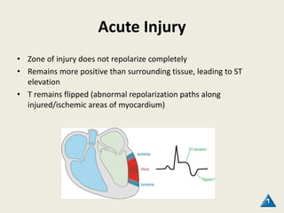 Acute Injury
• Zone of injury does not repolarize completely
• Remains more positive than surrounding tissue, leading to ST
elevation
• T remains flipped (abnormal repolarization paths along
injured/ischemic areas of myocardium)
96
 