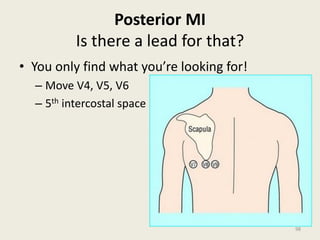 Posterior MI
Is there a lead for that?
• You only find what you’re looking for!
– Move V4, V5, V6
– 5th intercostal space
98
 