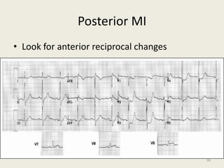 Posterior MI
• Look for anterior reciprocal changes
99
 