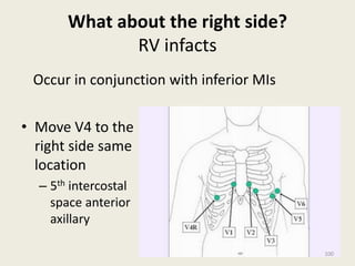 What about the right side?
RV infacts
• Move V4 to the
right side same
location
– 5th intercostal
space anterior
axillary
Occur in conjunction with inferior MIs
100
 