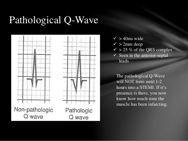 pathological q wave pathological q wave