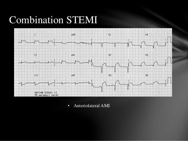 12 lead interpretation 12 lead interpretation