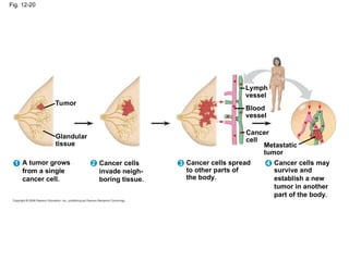 Fig. 12-20
Tumor
A tumor grows
from a single
cancer cell.
Glandular
tissue
Lymph
vessel
Blood
vessel
Metastatic
tumor
Cancer
cell
Cancer cells
invade neigh-
boring tissue.
Cancer cells spread
to other parts of
the body.
Cancer cells may
survive and
establish a new
tumor in another
part of the body.
1 2 3 4
 