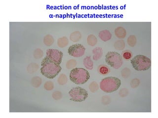 Reaction of monoblastes of
α-naphtylacetateesterase
 