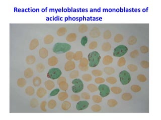Reaction of myeloblastes and monoblastes of
acidic phosphatase
 