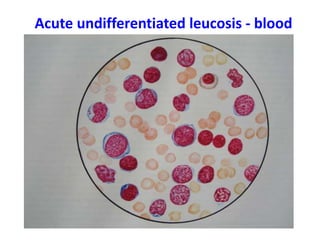 Acute undifferentiated leucosis - blood
 