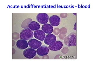 Acute undifferentiated leucosis - blood
 