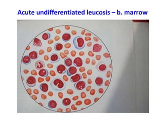 Acute undifferentiated leucosis – b. marrow
 